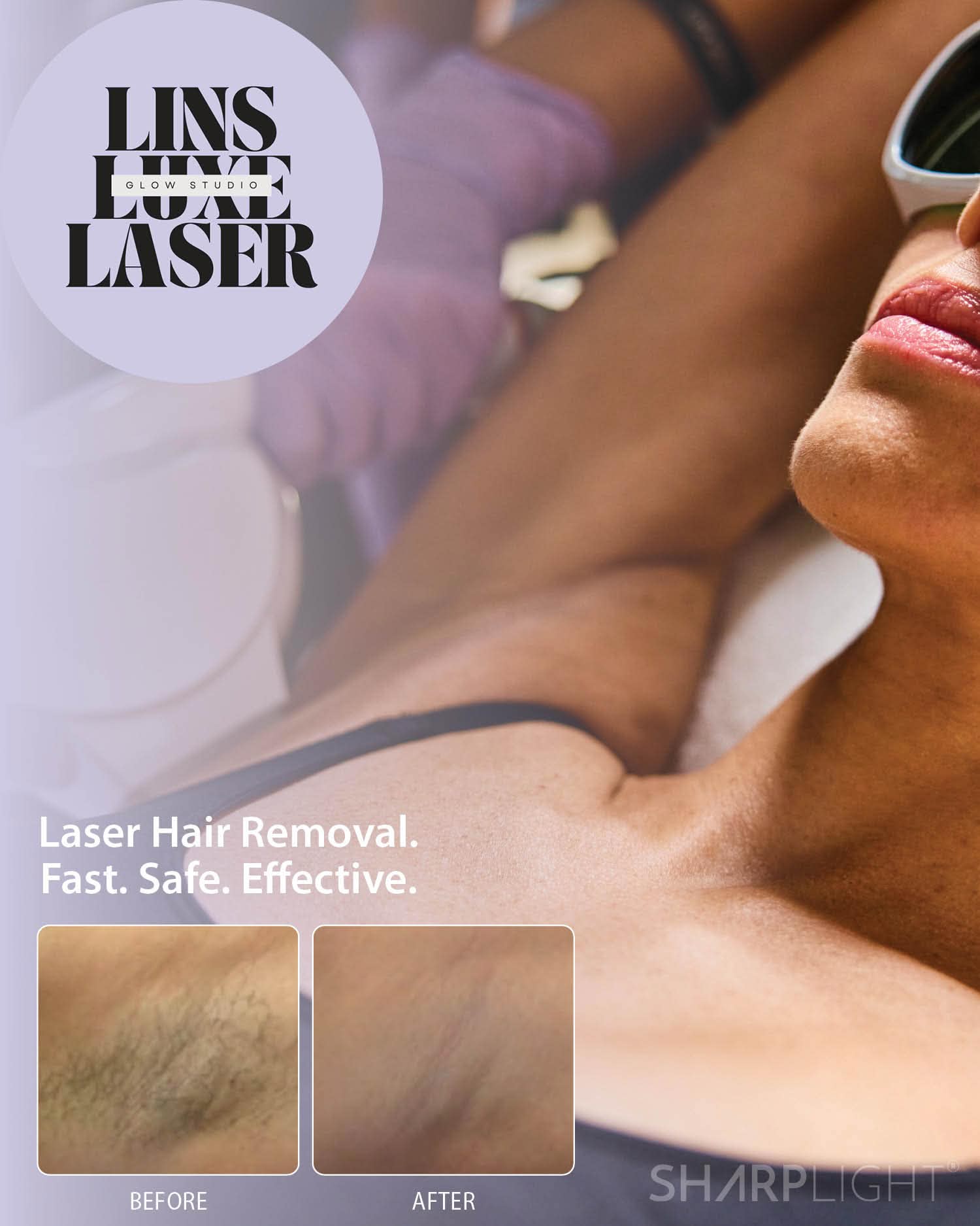 Laser hair removal, fast, safe, effective